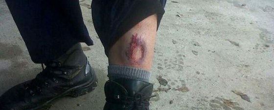 HERIDA DE UN AGENTE DE LA UIP Fotografía cedida por el SUP, que muestra las heridas de agentes durante un entrenamiento en Jaén
